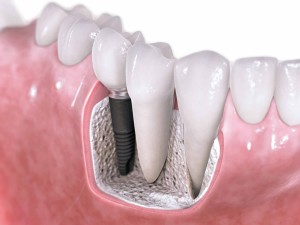 Dental Implants Barrington IL