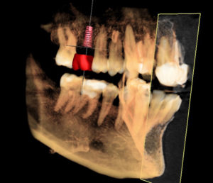 Conebeam image of Dental Implant Planning