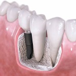 Dental Implants Barrington IL
