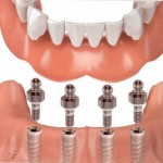 Implant Supported Dentures